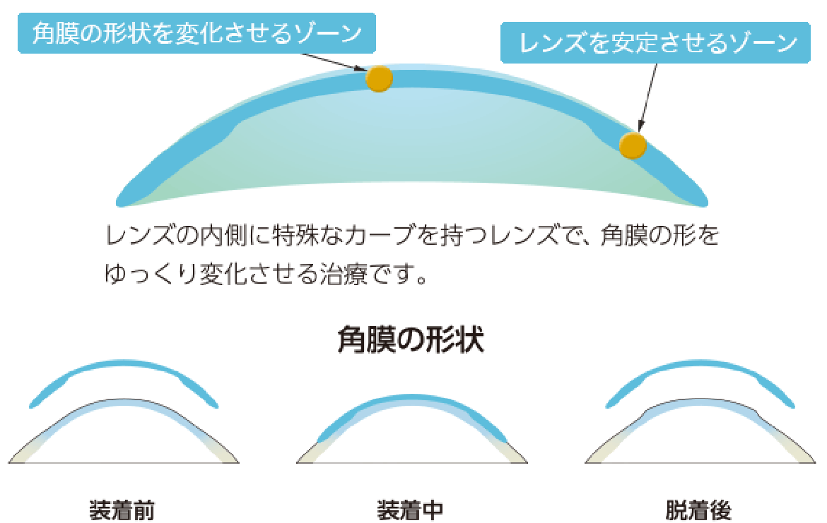 図：特殊なレンズデザインが角膜の形状を矯正する様子